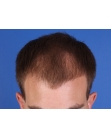 Before Hair Transplant&nbsp;Front
